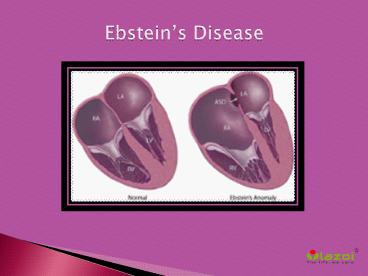 Ebstein’s Disease