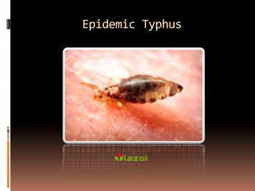 Epidemic Typhus