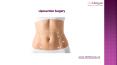 About Liposuction Surgery | theNewyou PowerPoint PPT Presentation