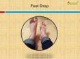 Foot Drop PowerPoint PPT Presentation