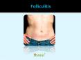 Folliculitis PowerPoint PPT Presentation