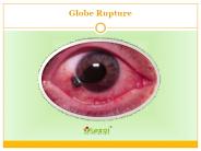 Globe Rupture