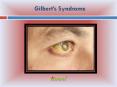 Gilbert’s Syndrome PowerPoint PPT Presentation