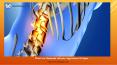What are Minimally Invasive Approaches to Spine - Dr Mehta Spine PowerPoint PPT Presentation