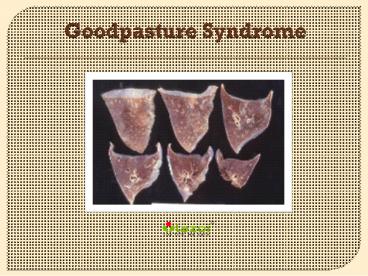 Goodpasture Syndrome