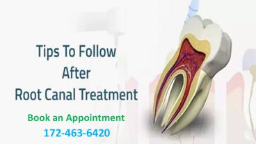 Tips To Follow after Root Canal Treatment