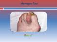 Hammer Toe PowerPoint PPT Presentation