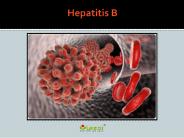 Hepatitis B