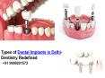 Types of Dental Implants in Delhi-Dentistry Redefined PowerPoint PPT Presentation