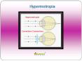 Hypermetropia: Causes, Symptoms, Daignosis, Prevention and Treatment PowerPoint PPT Presentation