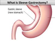What is Sleeve Gastrectomy?
