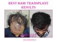 Best Hair Transplant Results PowerPoint PPT Presentation