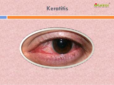 Keratitis: Causes, Symptoms, Daignosis, Prevention and Treatment