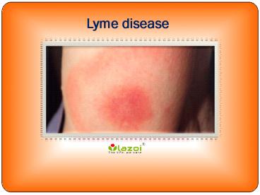 Lyme disease : Causes, Symptoms, Daignosis, Prevention and Treatment