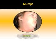 Mumps: Causes, Symptoms, Daignosis, Prevention and Treatment