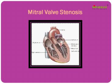 Mitral Valve Stenosis: Causes, Symptoms, Daignosis, Prevention and Treatment