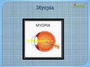 Myopia: Causes, Symptoms, Daignosis, Prevention and Treatment