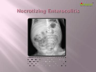 Necrotizing Enterocolitis: Causes, Symptoms, Daignosis, Prevention and Treatment (1)