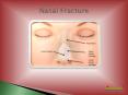 Nasal Fracture : Broken Nose Symptoms, Signs, Surgery & Treatment PowerPoint PPT Presentation