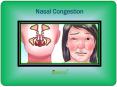 Nasal Congestion: Causes, Symptoms, Diagnosis and Treatment PowerPoint PPT Presentation
