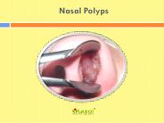 Nasal Polyps: Symptoms, causes, Diagnosis and Treatment