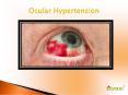 Ocular Hypertension: Causes, Symptoms, Daignosis, Prevention and Treatment PowerPoint PPT Presentation