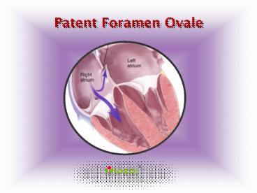Patent Foramen Ovale: Causes, Symptoms, Daignosis, Prevention and Treatment