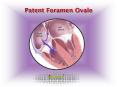 Patent Foramen Ovale: Causes, Symptoms, Daignosis, Prevention and Treatment PowerPoint PPT Presentation