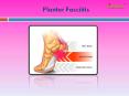 Plantar Fasciitis: Causes, Symptoms, Daignosis, Prevention and Treatment PowerPoint PPT Presentation