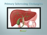 Primary Sclerosing Cholangitis: Causes, Symptoms, Daignosis, Prevention and Treatment