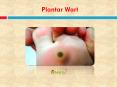 Plantar Wart: Causes, Symptoms, Daignosis, Prevention and Treatment PowerPoint PPT Presentation