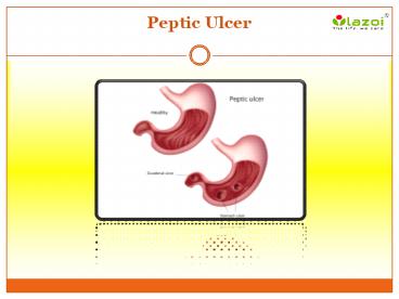 Peptic Ulcer: Causes, Symptoms, Daignosis, Prevention and Treatment
