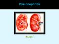 Pyelonephritis: Causes, Symptoms, Daignosis, Prevention and Treatment PowerPoint PPT Presentation