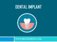 How Dental Implant Save Your Smile | Brandon Dentist PowerPoint PPT Presentation