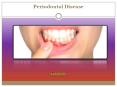What is Periodontal Disease? Read More about Symptoms and Treatment PowerPoint PPT Presentation