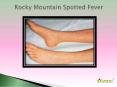 Rocky Mountain spotted fever: Causes, Symptoms, Daignosis, Prevention and Treatment PowerPoint PPT Presentation