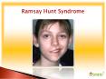 Ramsay Hunt Syndrome: Causes, Symptoms, Daignosis, Prevention and Treatment PowerPoint PPT Presentation