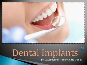 Dental implants by Dr. Anderson - Select Care Dental (1)