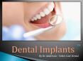 Dental implants by Dr. Anderson - Select Care Dental (1) PowerPoint PPT Presentation