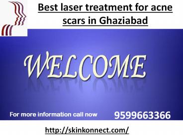 Best Treatment for Acne Scars