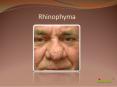 Rhinophyma: Causes, Symptoms, Daignosis, Prevention and Treatment PowerPoint PPT Presentation