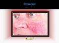 Rosacea: Causes, Symptoms, Daignosis, Prevention and Treatment PowerPoint PPT Presentation
