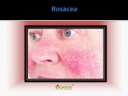 Rosacea: Causes, Symptoms, Daignosis, Prevention and Treatment