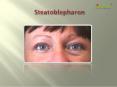 Steatoblepharon: Causes, Symptoms, Daignosis, Prevention and Treatment PowerPoint PPT Presentation