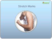 How to get rid of stretch marks