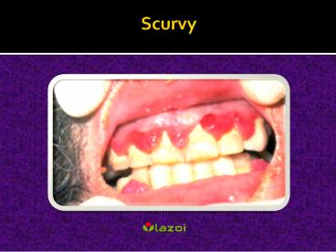 Scurvy: Causes, Symptoms, Daignosis, Prevention and Treatment