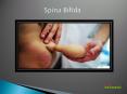 Spina Bifida: Causes, Symptoms, Daignosis, Prevention and Treatment PowerPoint PPT Presentation
