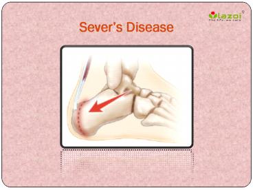 Pes Cavus: Causes, Symptoms, Daignosis, Prevention and Treatment (1)