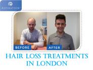 Hair Loss Treatments In London