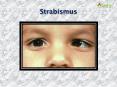 Strabismus: Causes, Symptoms, Daignosis, Prevention and Treatment PowerPoint PPT Presentation